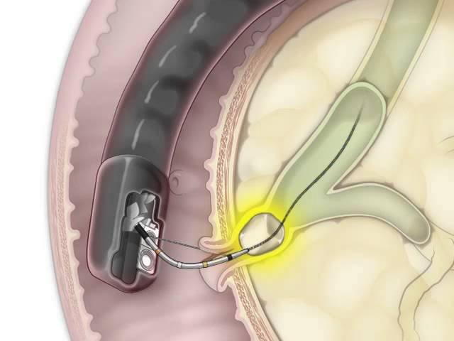 ERCP & Stone Extraction
